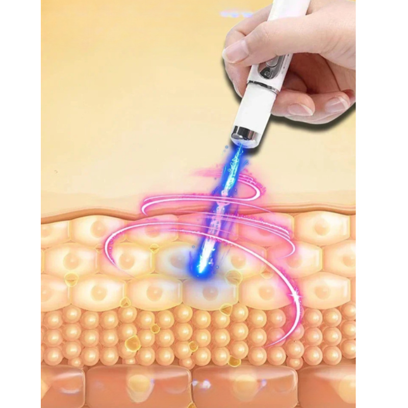 SkinRenew – Laser-Therapiegerät für Hautregeneration und Narbenreduktion